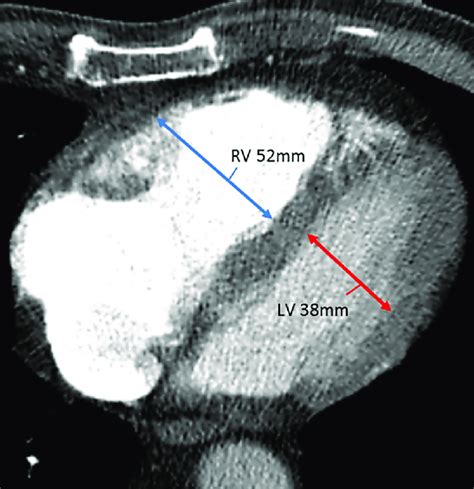 rv lv ratio measurement.